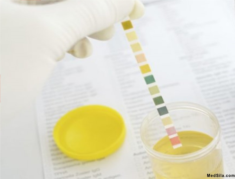 Анализ мочи